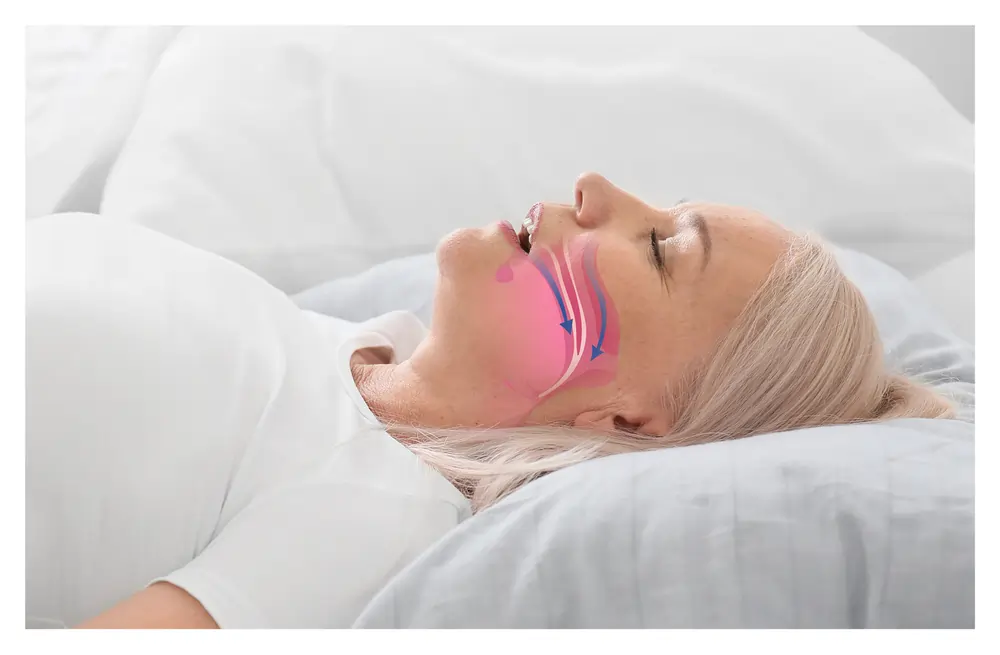 Sleep Apnea: Everything You Need to Know